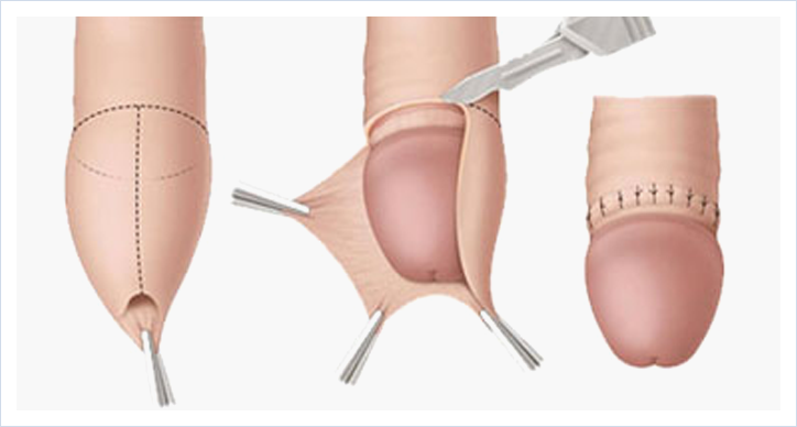 Basic Conventional Circumcision Surgery Nagpur