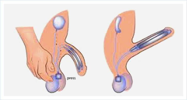 Non-graphic medical illustration of penile implant treatment option