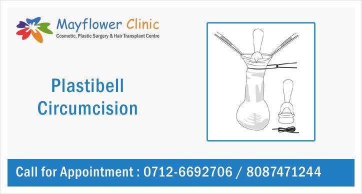 Plastibel Circumcision for Infants Nagpur