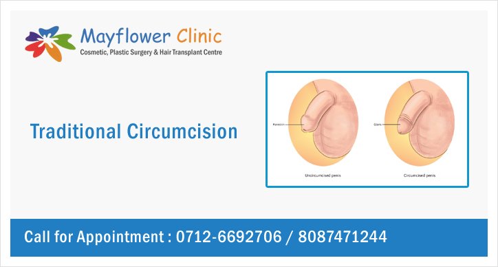 Traditional Circumcision Surgery Nagpur