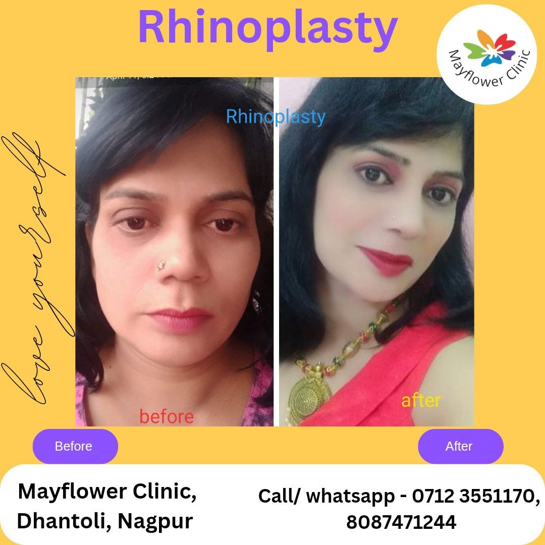 Nasal dorsum augmentation before and after clinical photograph Mayflower Clinic