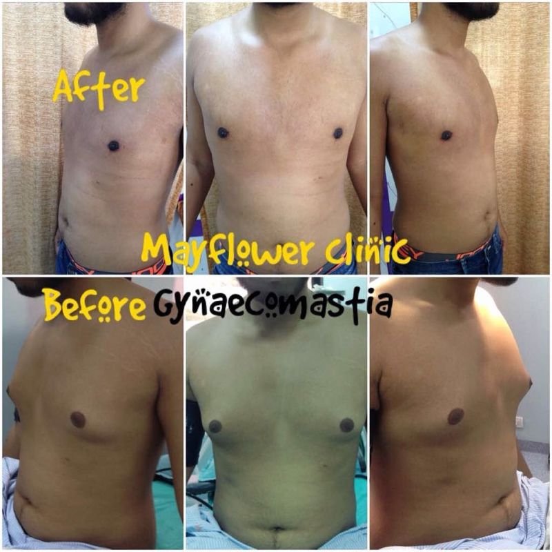 Gynecomastia surgery consultation image Mayflower Clinic Nagpur