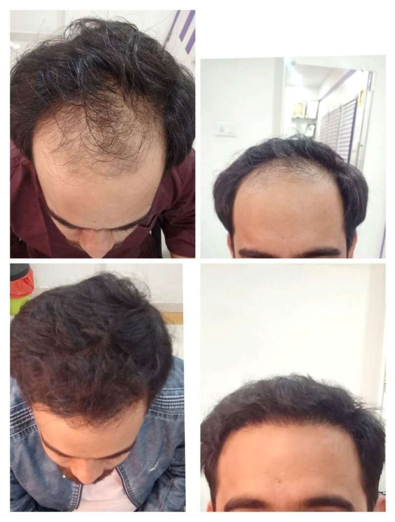 FUE hair transplant results at Mayflower Clinic Nagpur