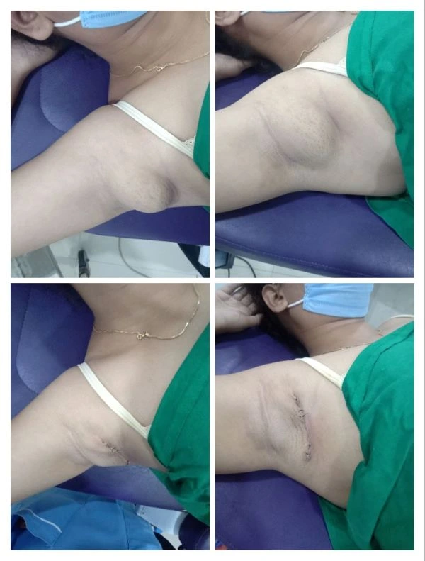 Before and after accessory axillary breast tissue removal by surgical excision at Mayflower Clinic Nagpur