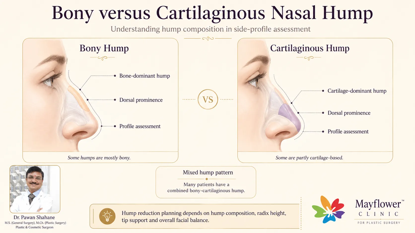 Bony hump versus cartilaginous hump comparison for nasal hump removal planning