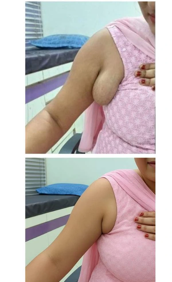 Before and after combined axillary liposuction and tissue excision by Dr. Pawan Shahane in Nagpur