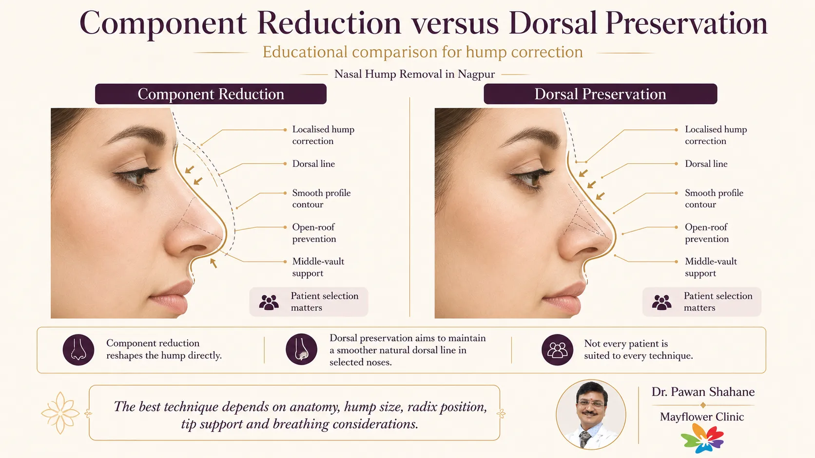 Component reduction versus dorsal preservation comparison for nasal hump correction