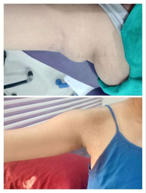 Before and after localized liposuction for fat-dominant armpit fullness by Dr. Pawan Shahane in Nagpur