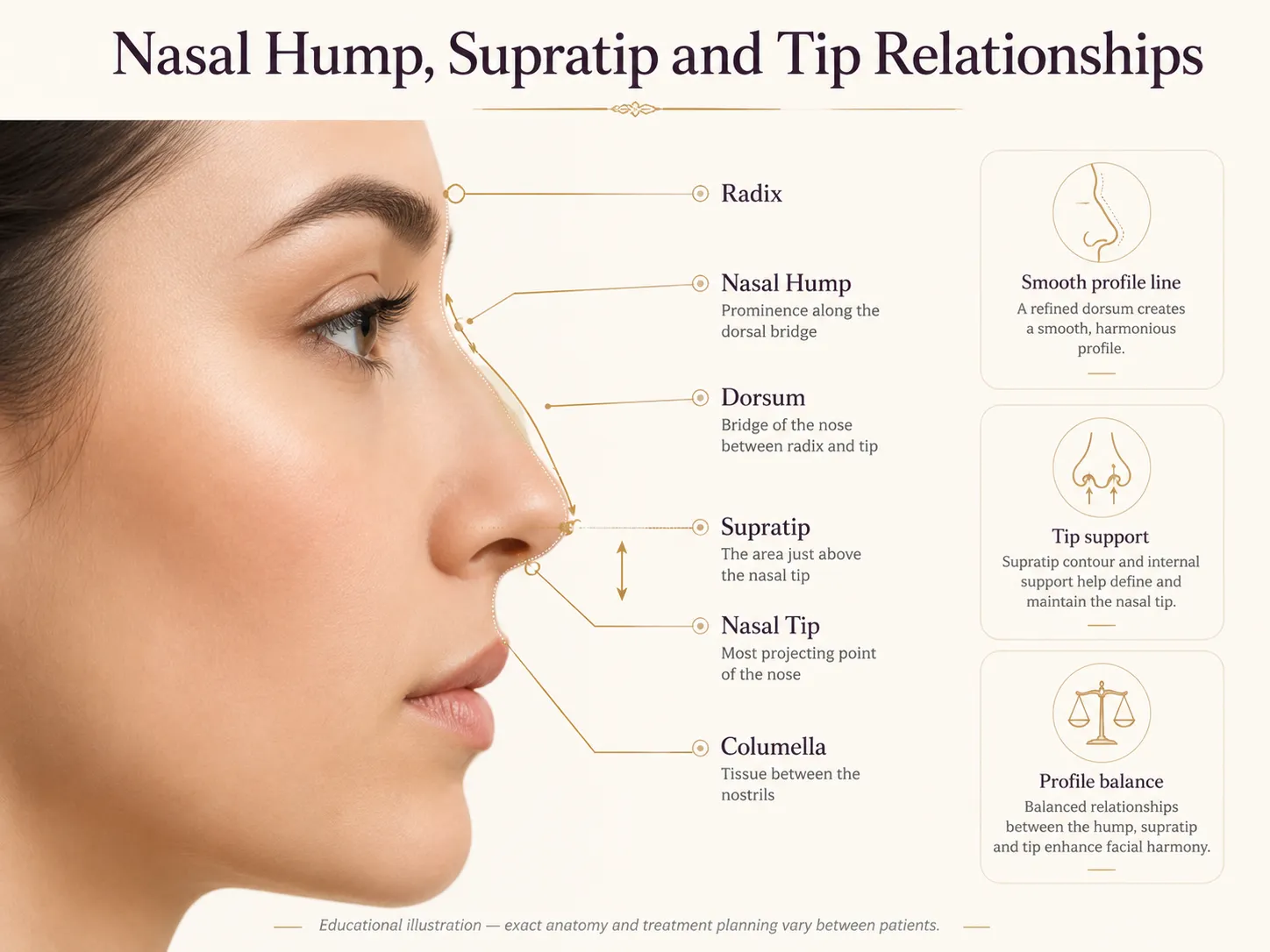 Nasal hump, supratip and nasal tip profile relationship diagram