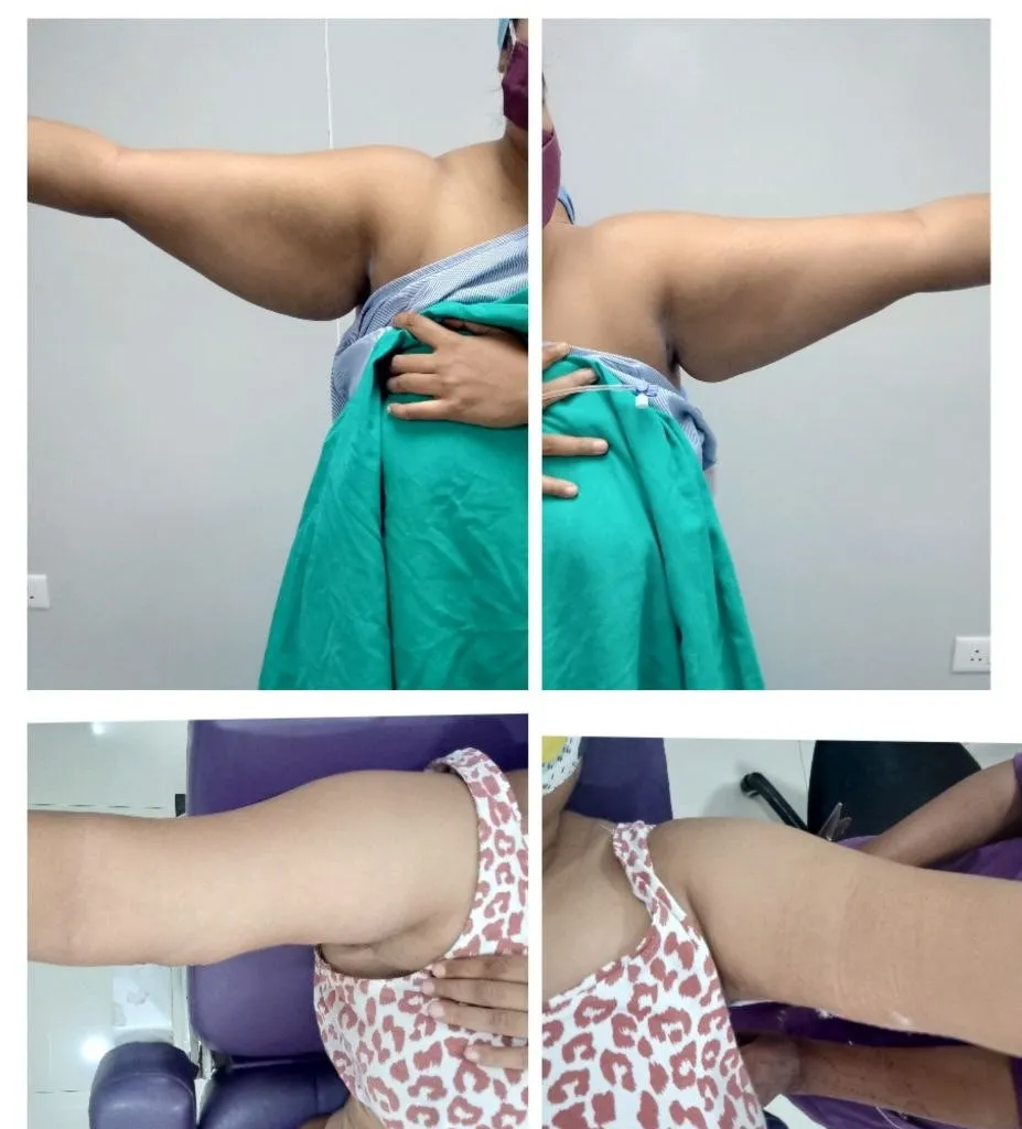 Arm contouring before and after case 2 showing a more proportionate upper-arm outline