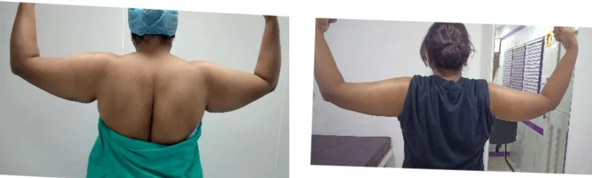 Arm liposuction before and after case 1 showing improvement in localized upper-arm fullness