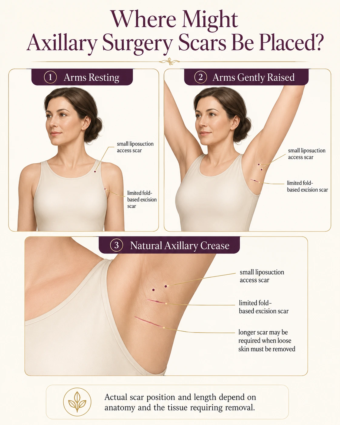 Educational diagram showing small liposuction access scars and fold-based accessory axillary tissue excision scar placement