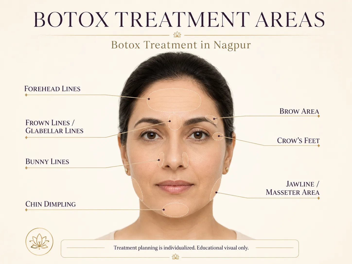 Botox treatment areas illustration for patient education
