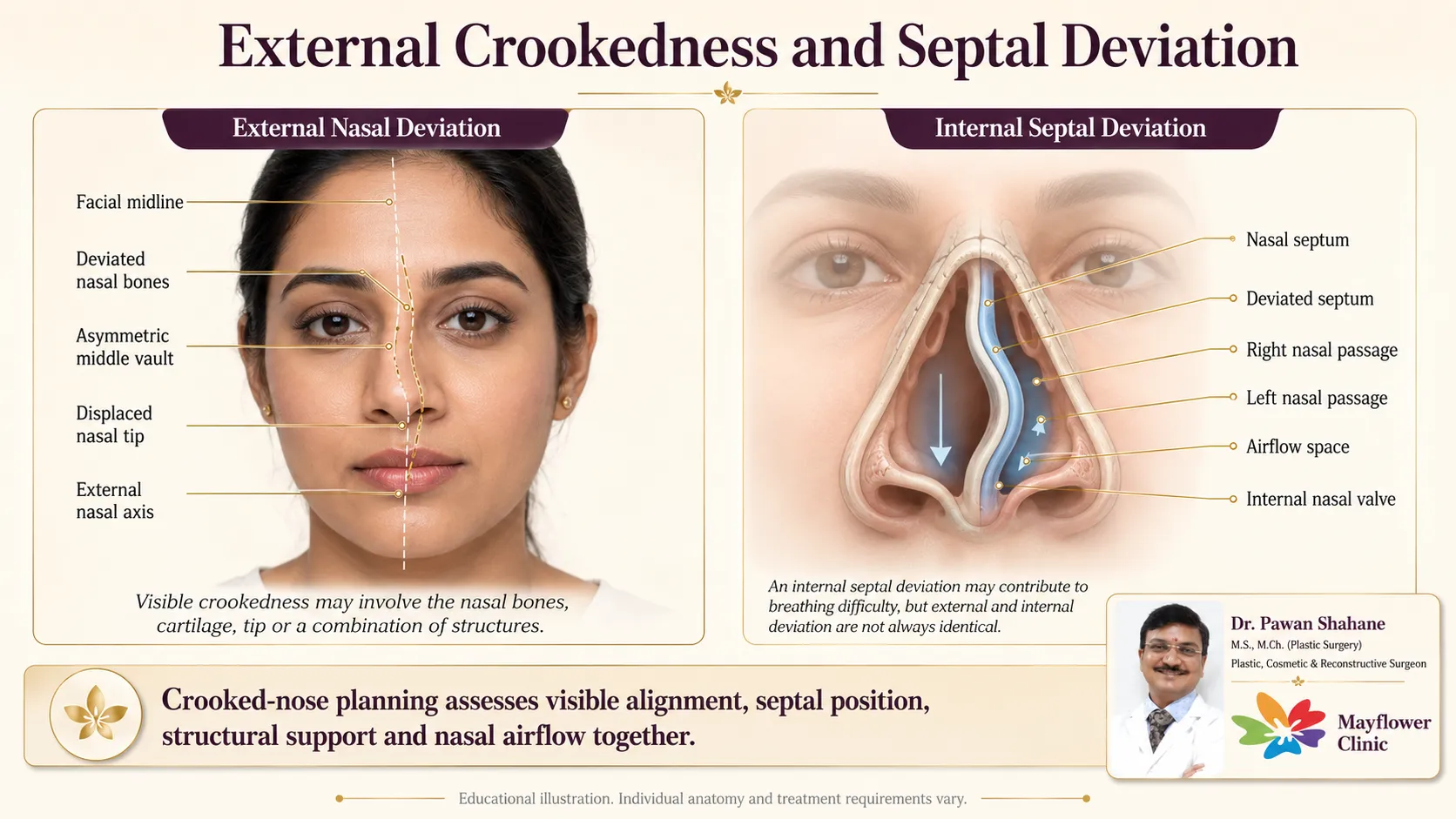 External crooked nose versus internal deviated septum comparison diagram