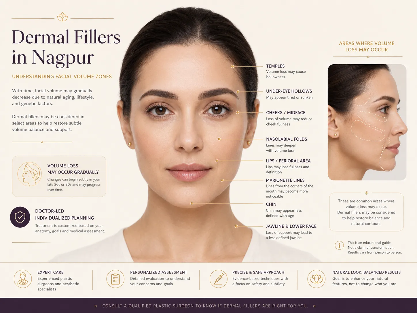 Dermal filler facial volume zones illustration showing temples, under-eye hollows, cheeks, folds, lips, chin and jawline