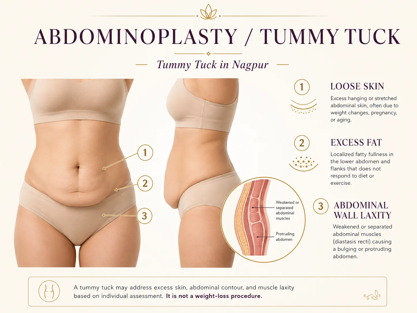 Medical illustration showing loose abdominal skin, subcutaneous fat and abdominal wall laxity in tummy tuck planning