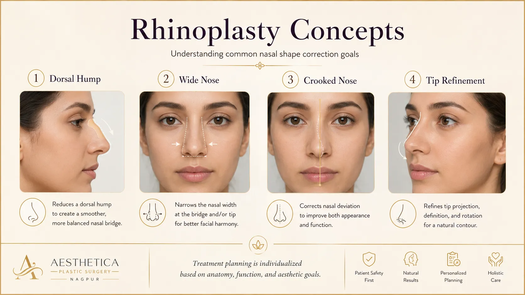 Nasal shape correction concepts including hump, wide nose, crooked nose and tip refinement