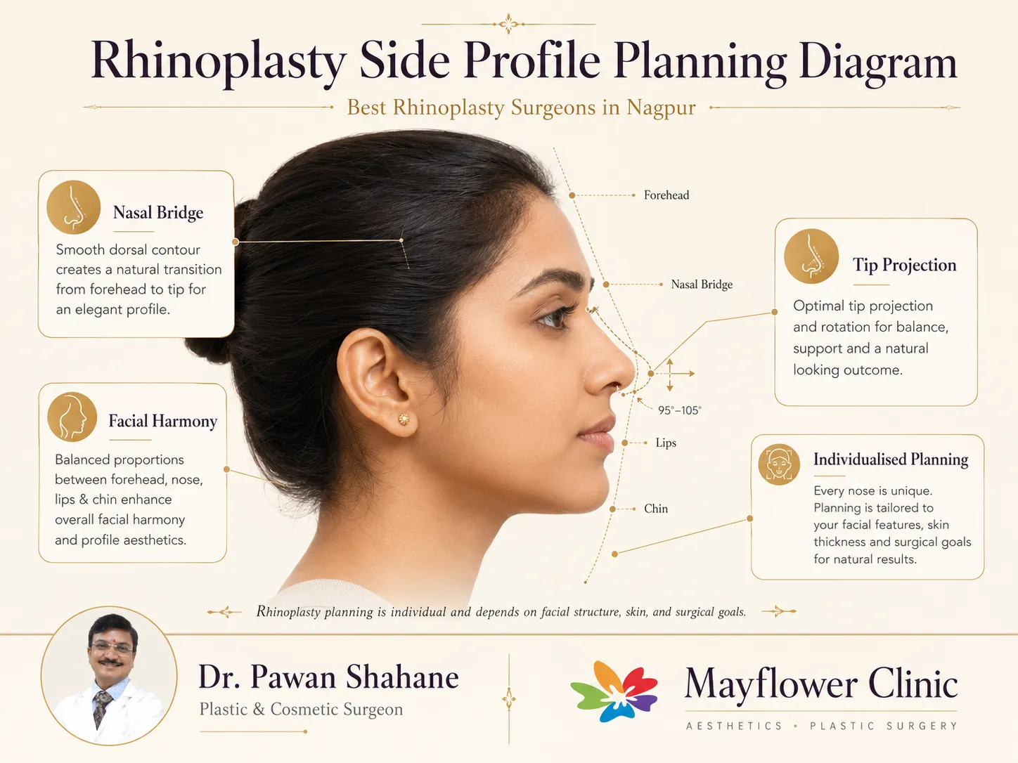 Rhinoplasty side profile planning diagram showing bridge and tip relationships