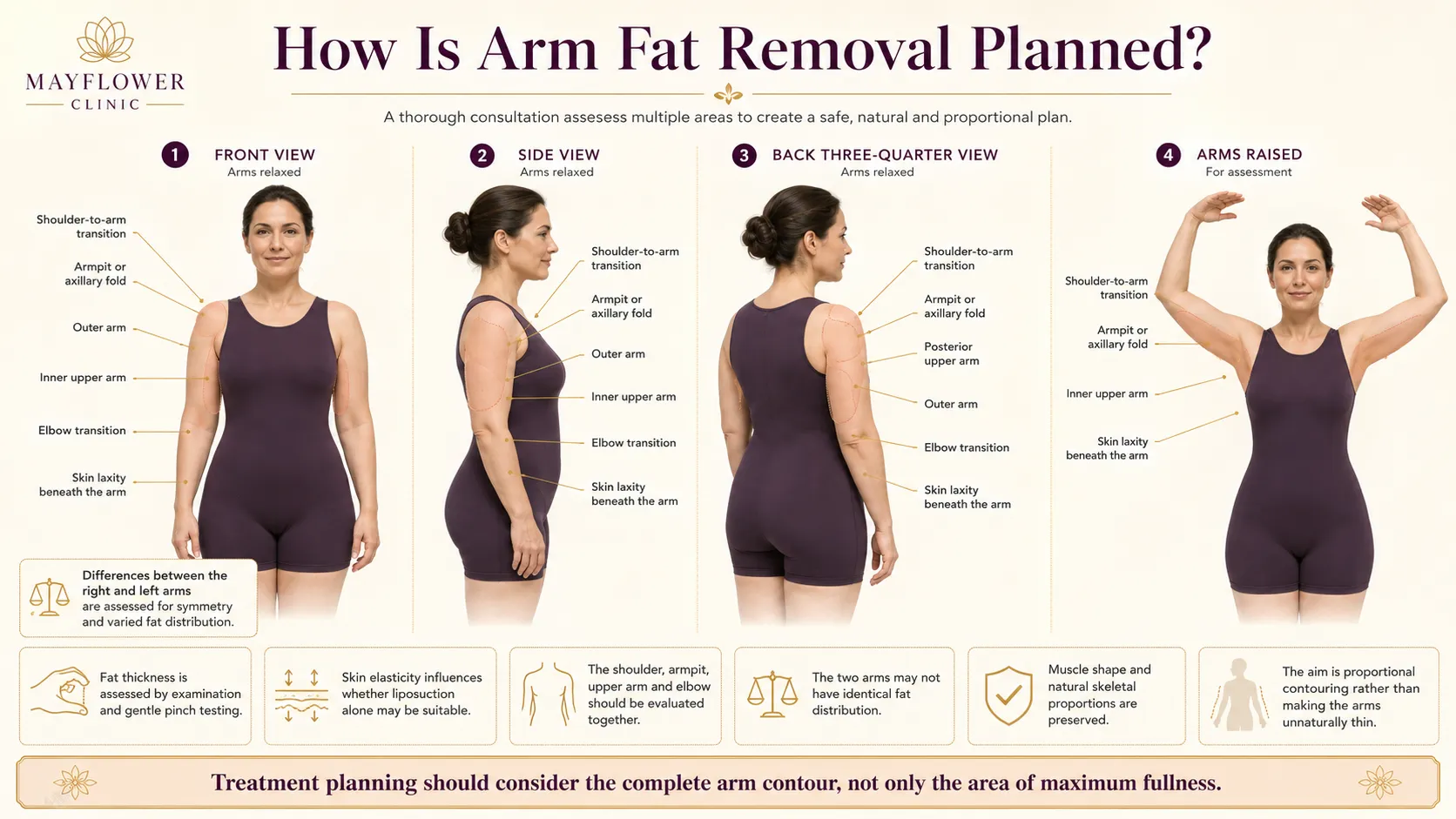 Upper-arm contouring assessment showing the arm zones examined before fat removal treatment