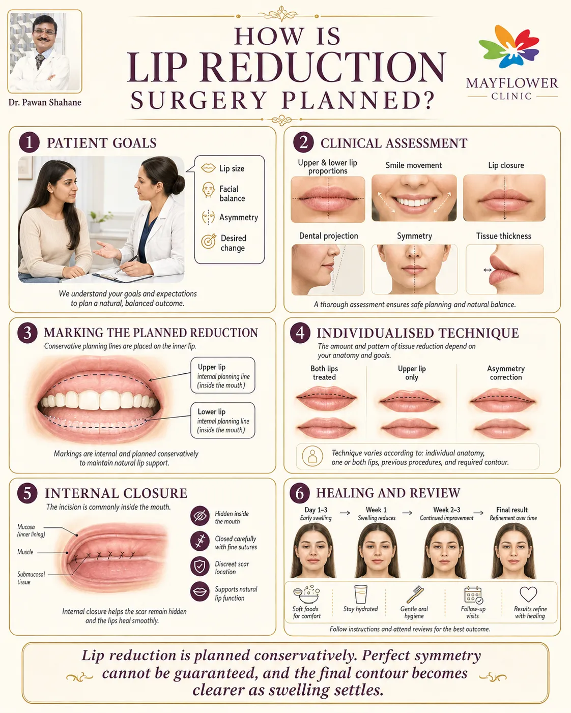 Six-step illustration showing consultation, assessment, conservative marking, internal-incision planning, closure and recovery after lip reduction surgery