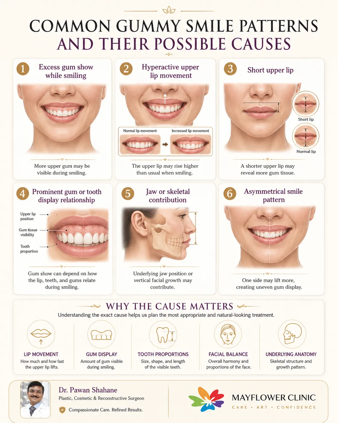 Medical infographic showing common gummy smile patterns including excessive gum display, hyperactive or short upper lip, gum-tooth relationship, jaw contribution and asymmetry