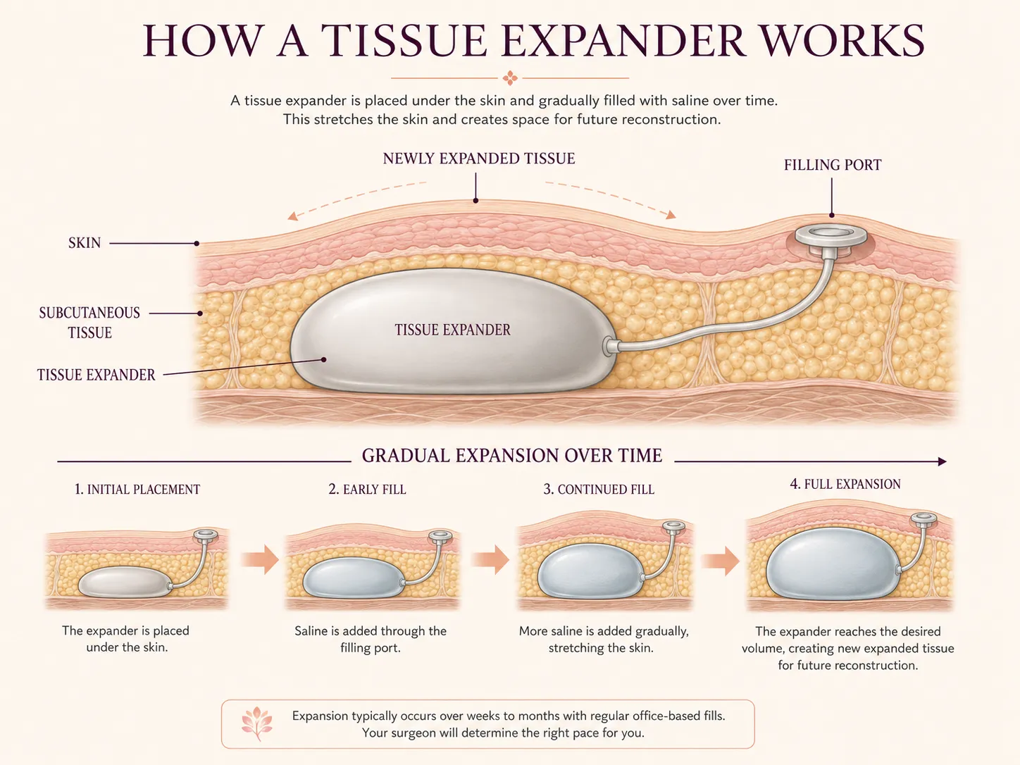 Medical illustration showing how a tissue expander gradually stretches skin and soft tissue