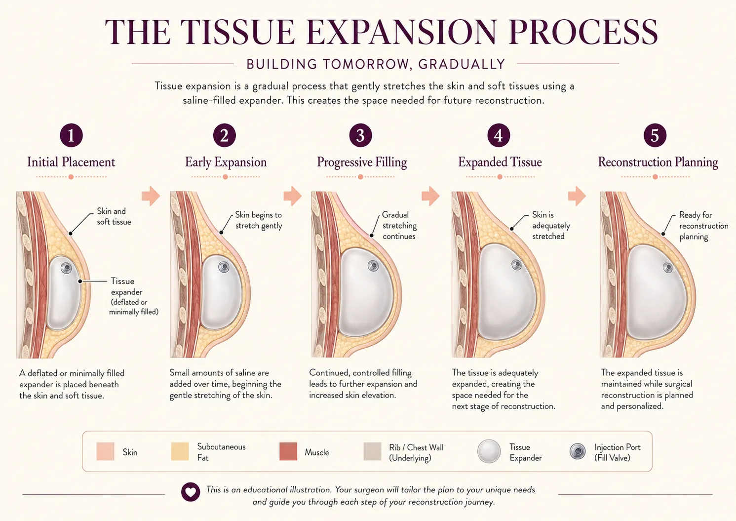 Stages of tissue expansion from placement through gradual expansion to reconstruction planning